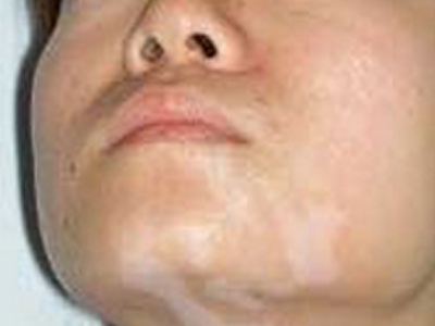 脸部白斑病怎么预防